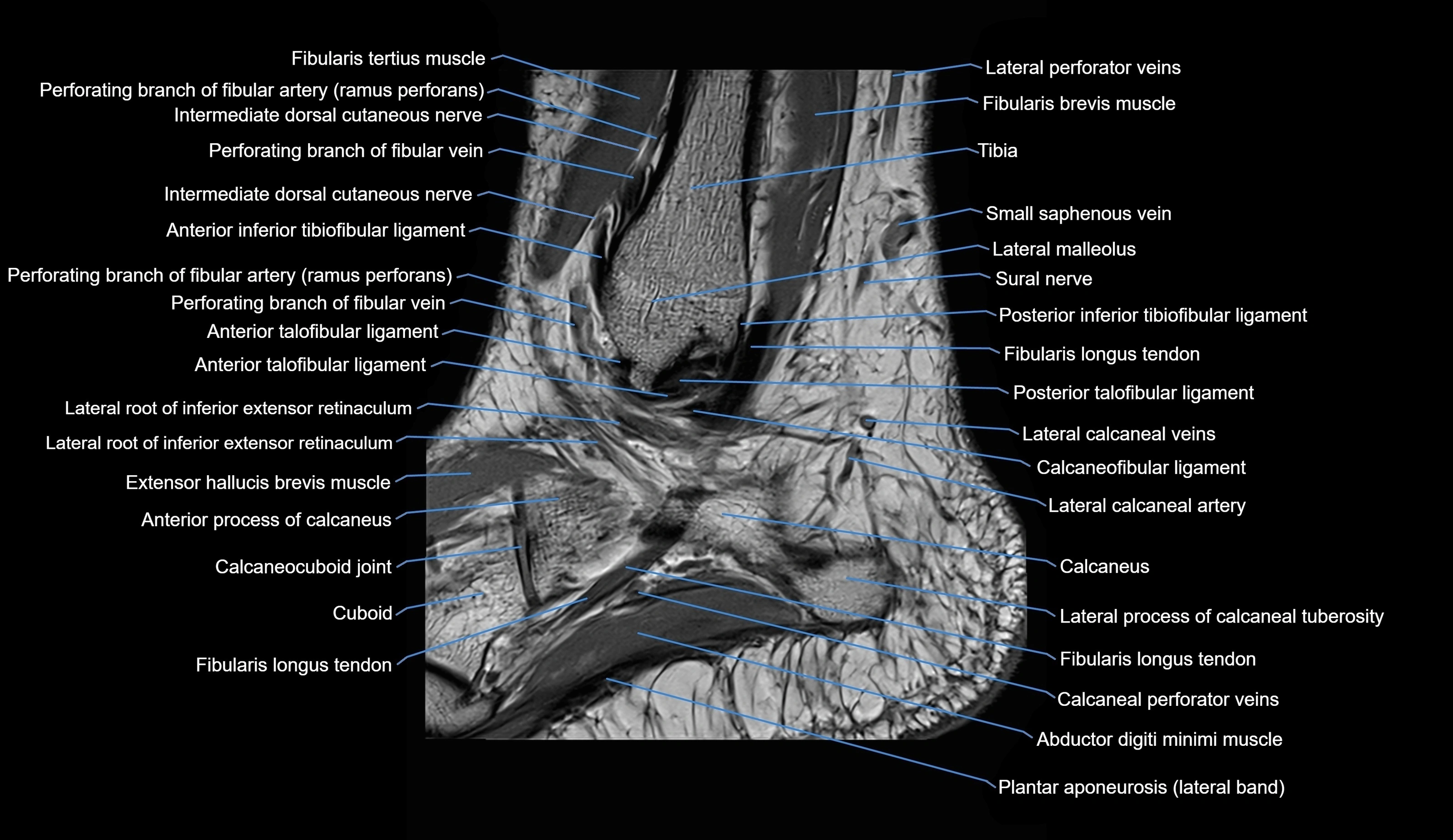 MRI Ankle sagittal cross sectional anatomy 3T  radiology  image-img-00001-00029.webp